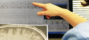 amartoma ipotalamico